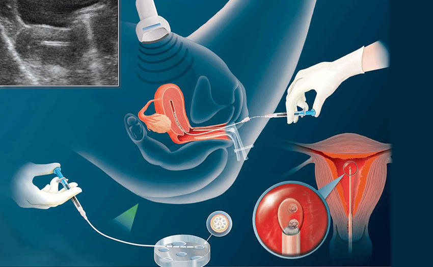 In-Vitro Fertilisation for infertility Cost