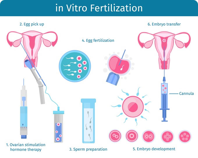 In-Vitro Fertilisation for infertility