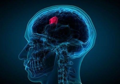 blood clot brain surgery cost in india